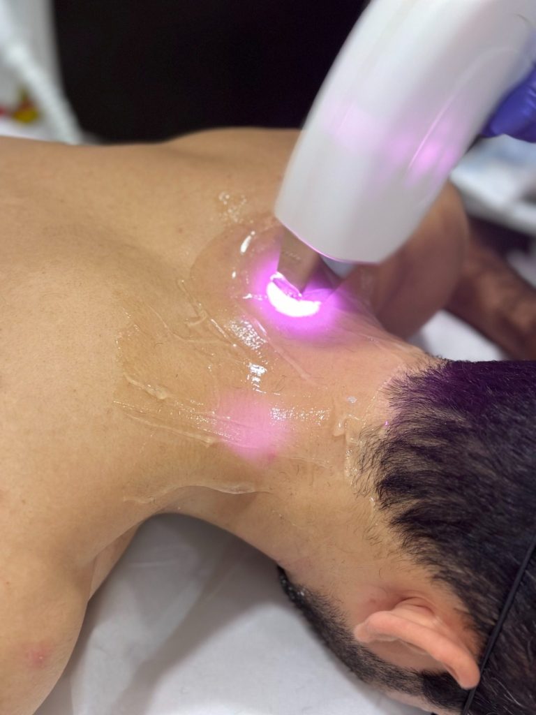 Muska Laserska epilacija podbradak i vrat u kozmetickom salonu