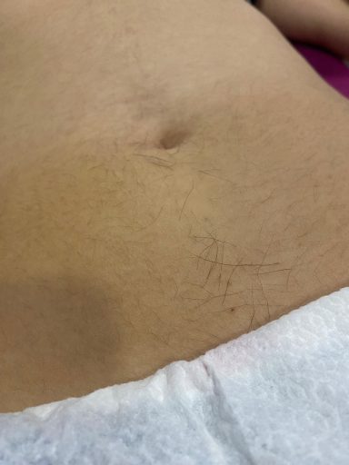 Detalj stomaka pre tretmana depilacije, sa vidljivim dlačicama koje će biti uklonjene voskom.