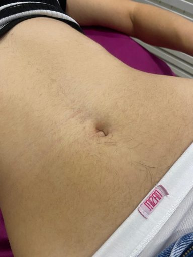 Detalj stomaka pre tretmana depilacije, sa vidljivim dlačicama koje će biti uklonjene voskom.