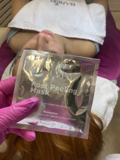 Post peeling maska posle TCA pilinga lica