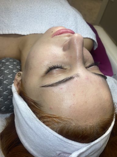 Procena kože pre TCA pilinga lica u salonu Angels Novi Sad
