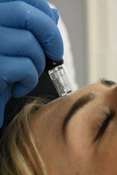 dermapen microneedling u kozmetickom salonu angels novi sad