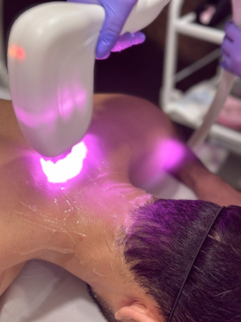 Muska Laserska epilacija podbradak i vrat u kozmetickom salonu