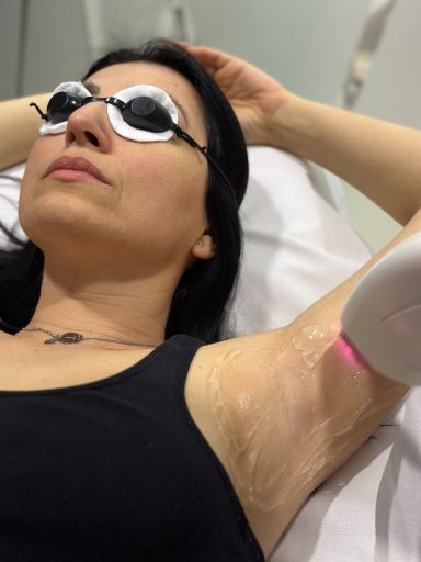 Žena mirno leži dok kozmetičarka izvodi laserski tretman na pazuhu, a laser je usmeren na tretirano područje.