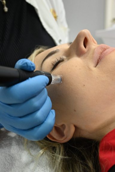 dermapen microneedling u kozmetickom salonu angels novi sad