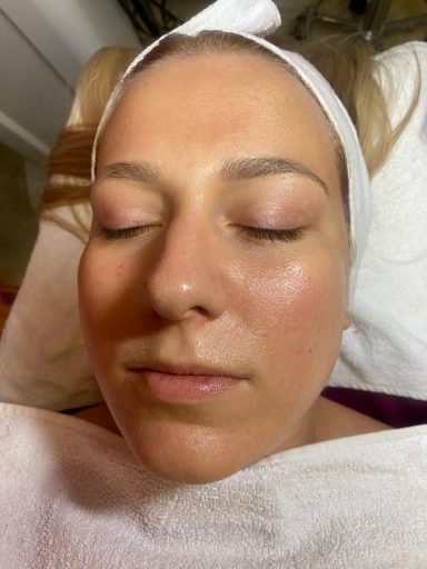 Nega lica nakon Vampire Infusion maske u salonu Angels Novi Sad